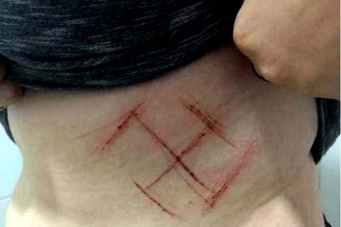 #EleNão: Mulher tem suástica marcada na pele por usar adesivo