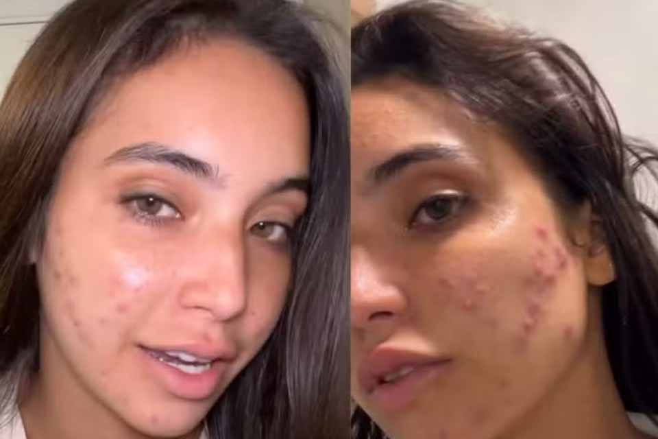 Vanessa Lopes mostra pele com Acne e fala sobre desafios: “Afeta a minha autoestima”