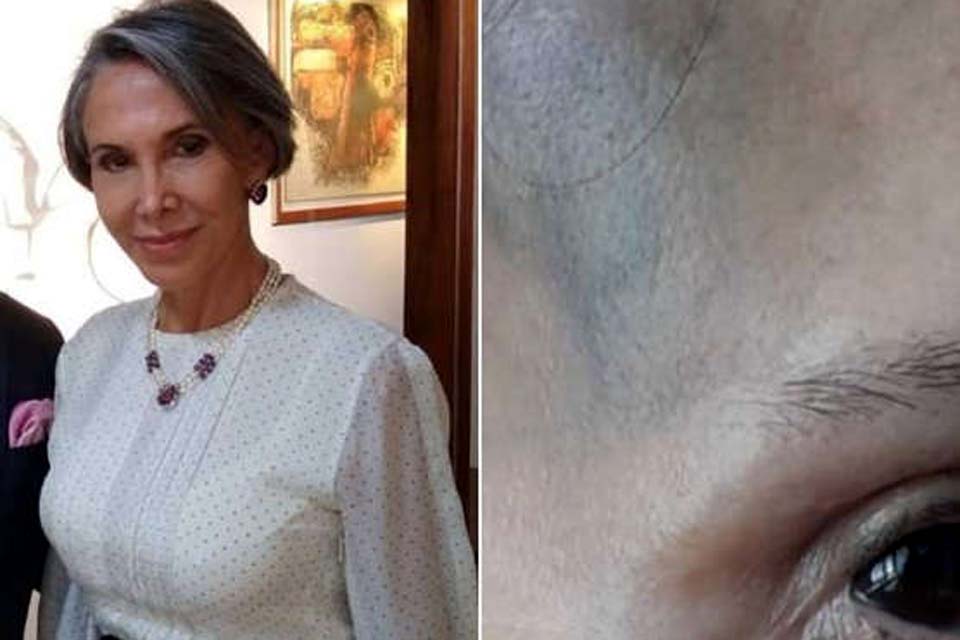 Florinda Meza assusta fãs ao aparecer com hematoma no rosto