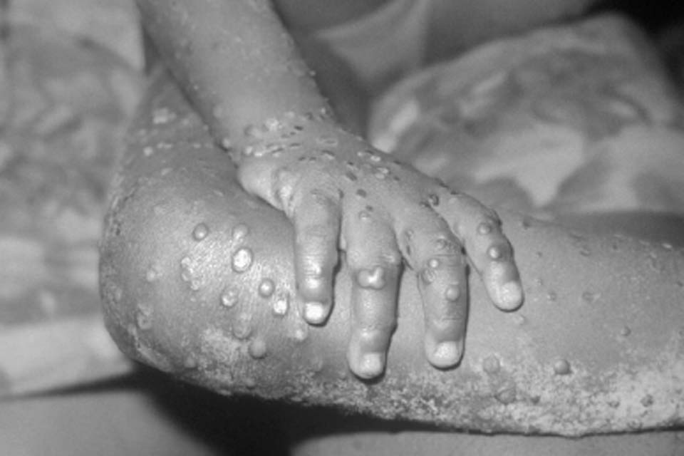 Brasil contabiliza 1,5 mil casos de mpox em 2024