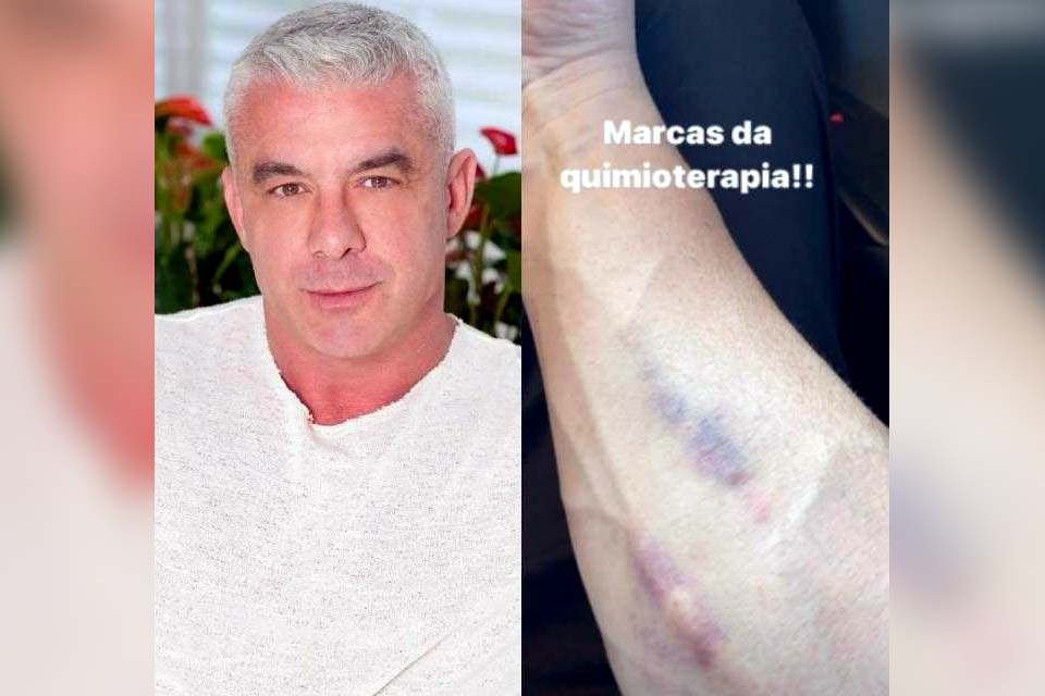 Marido de Ana Hickmann mostra hematomas no braço em meio a tratamento contra câncer