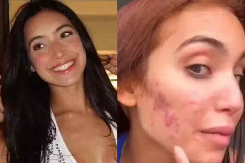 Vanessa Lopes desabafa sobre acne na fase adulta: “Eu gritava de dor”