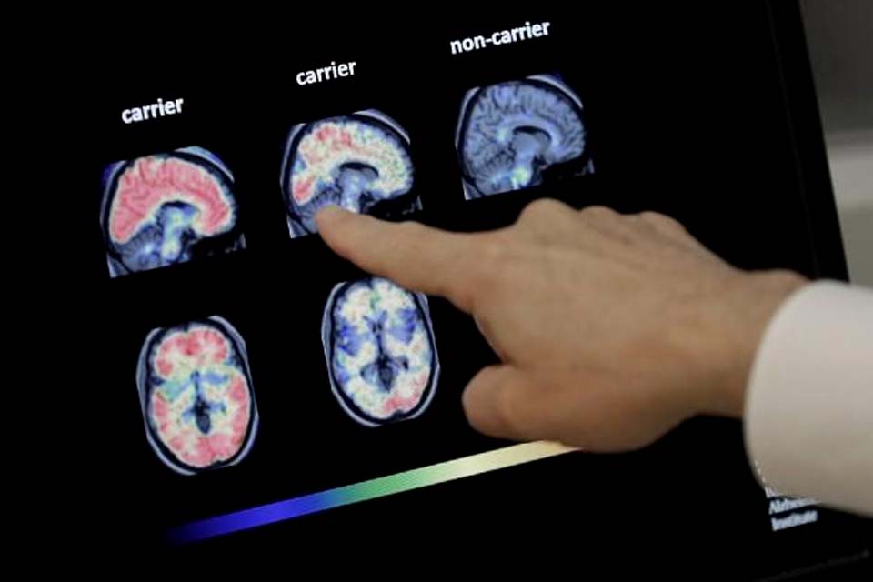 Remédio experimental consegue retardar progressão do Alzheimer