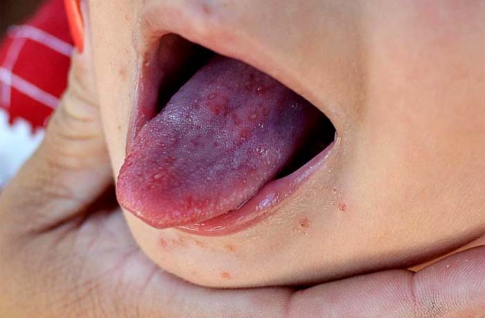 Registrados pelo menos 100 casos da doença mão-pé-boca 