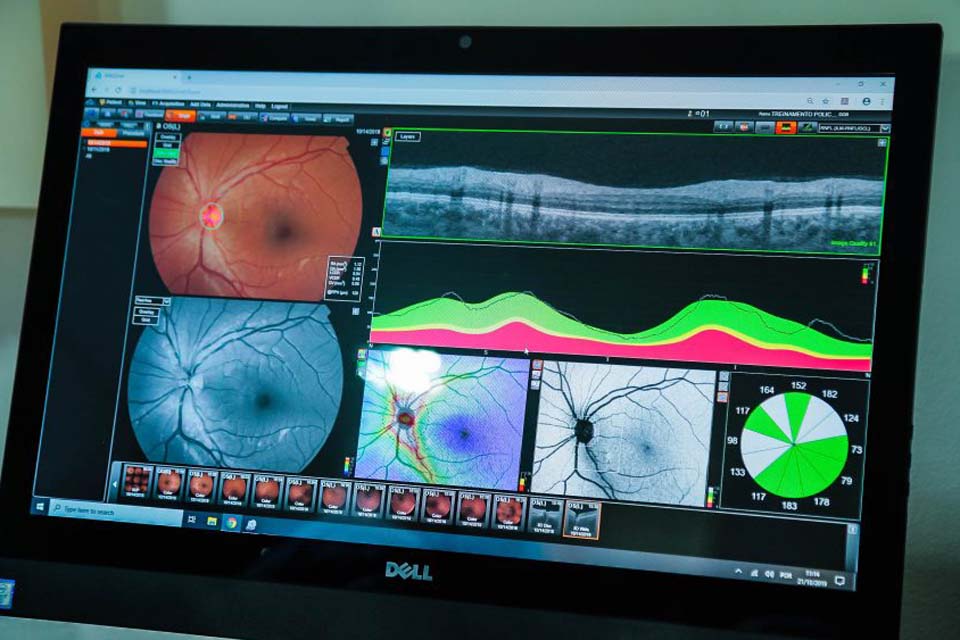 No Dia Nacional de Combate ao Glaucoma, Sesau reforça importância do diagnóstico precoce