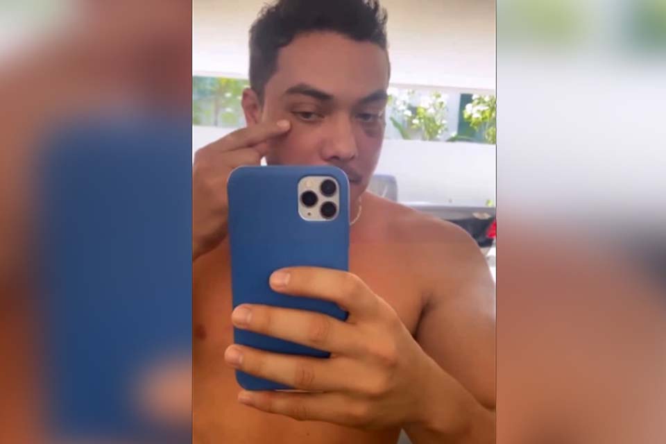 Depois de preocupar fãs, Wesley Safadão explica olho roxo