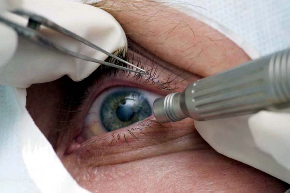 Pandemia faz cair detecção precoce de glaucoma