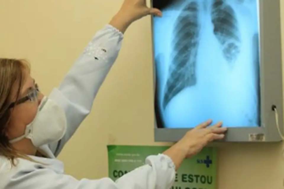 Tuberculose matou 5,8 mil brasileiros em 2022