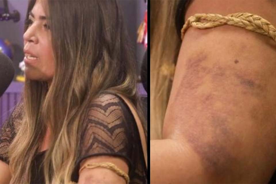 Bruna Surfistinha mostra hematomas e diz que sofreu agressões de seu ex-marido Xico Santos