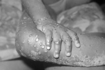 Mpox: OMS aprova primeira vacina para uso emergencial em crianças