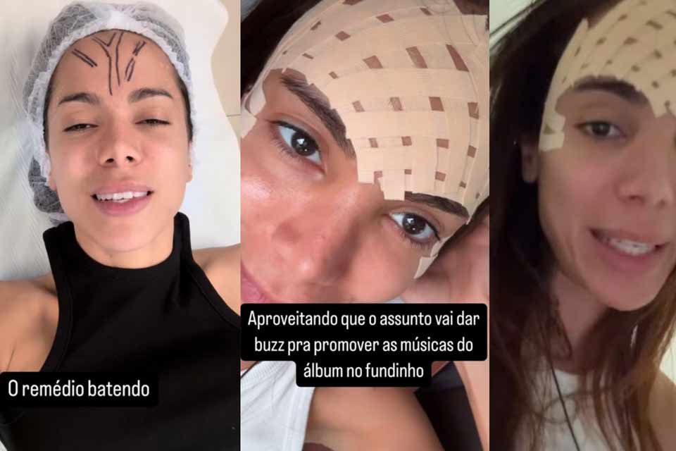 Anitta faz procedimento para remover veia saliente na testa: “Tirei, foi incrível”