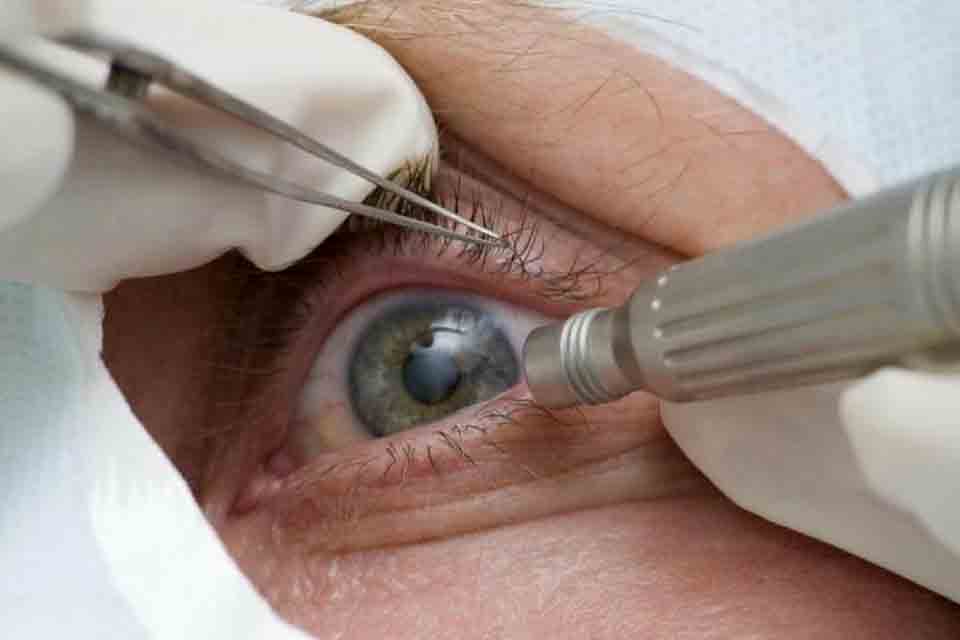 Guia tenta evitar expansão de casos de cegueira por glaucoma