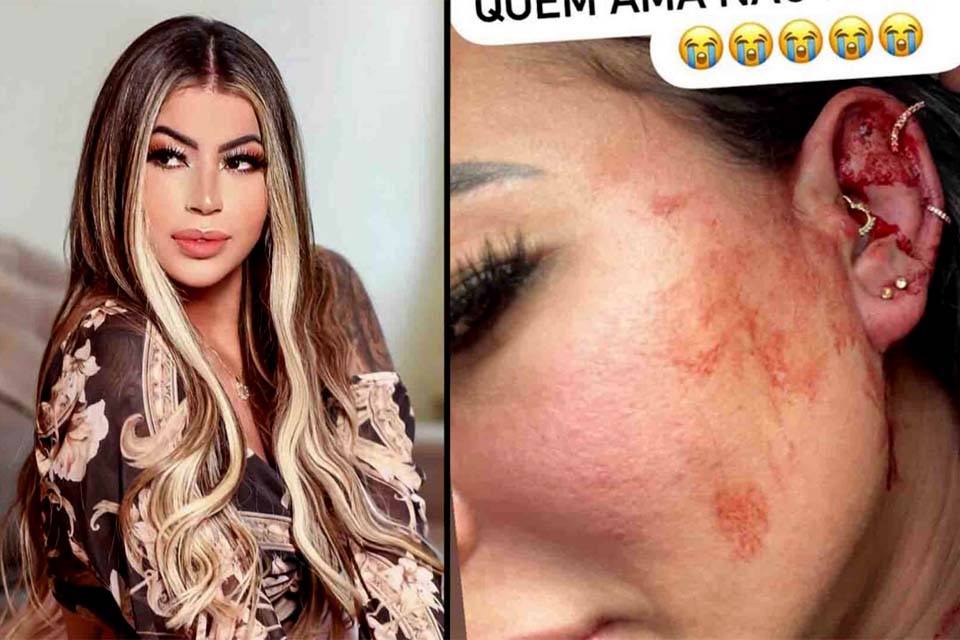 Influencer Milena Lins diz que foi agredida por namorado e posta fotos